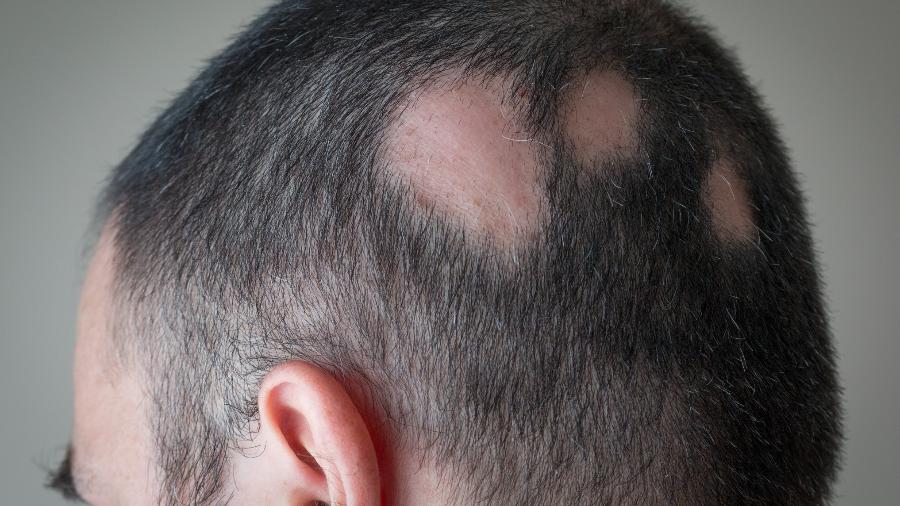 Anvisa aprovou novo medicamento para alopecia areata