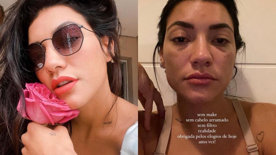 Gabi Prado explicou aos seguidores que olho roxo é decorrente de procedimento estético - Reprodução/Instagram @pradogabrielle
