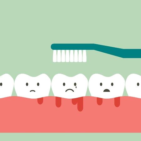 Condição geralmente é causada por gengivites que não foram tratadas corretamente - wissanu_phiphithaphong/iStock