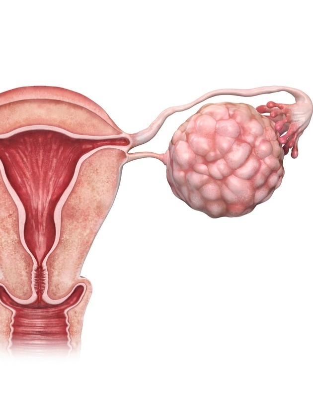 Apareceu um cisto no ovário? Veja o que fazer!