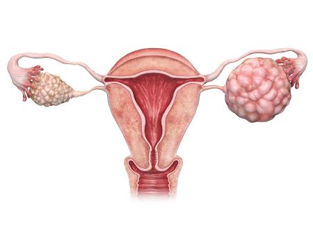 Câncer ovariano: o que é, causas, sintomas e tratamento - BoaConsulta