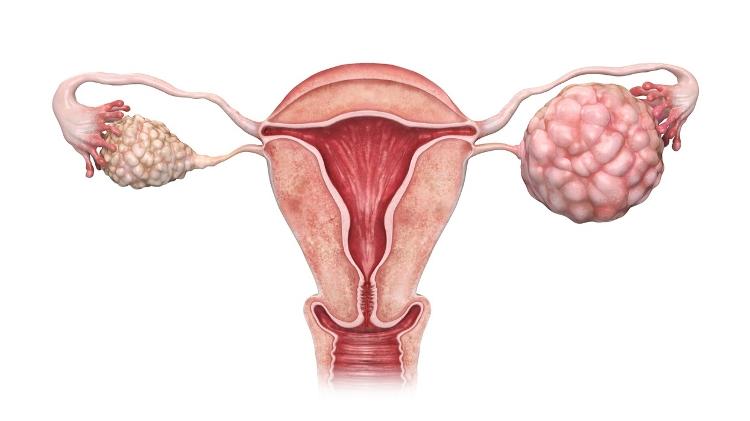 Illustration shows ovarian tumor, ovarian cancer - iStock - iStock