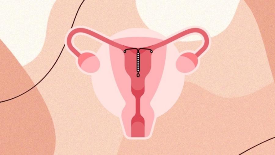 Dispositivo, ainda na fase 1 de testes em humanos, tem medicação que modula o hormônio progesterona – importante na regulação do ciclo menstrual – e pode ajudar mulheres com anemia - Arte de Lívia Magalhães com imagens de FlatIcon/Jornal da USP