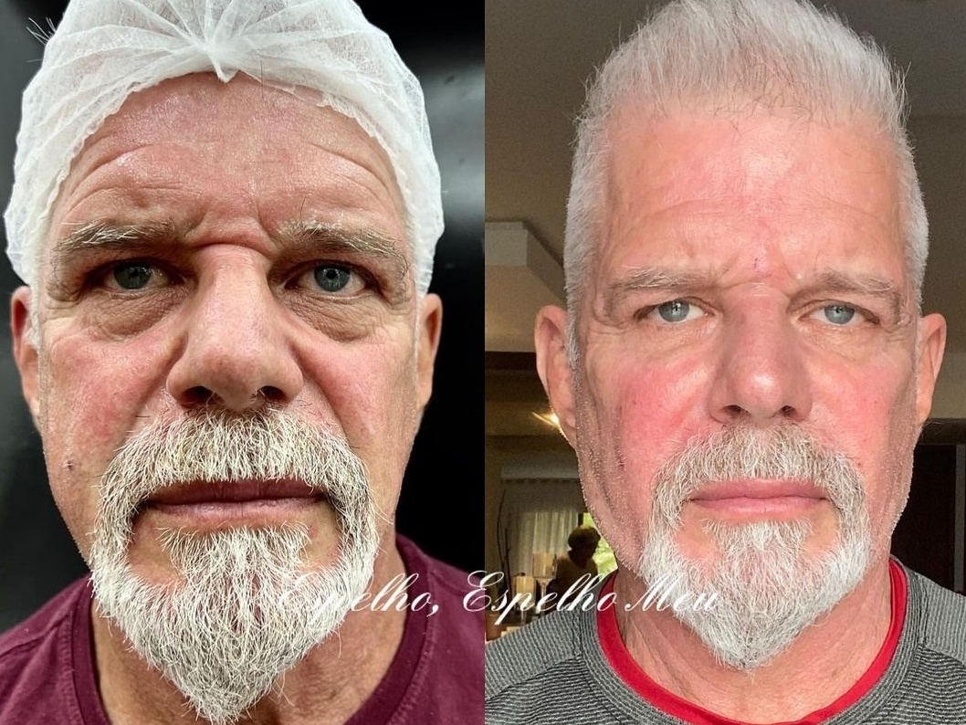 Raul Gazolla passa por harmonização facial; confira antes e depois