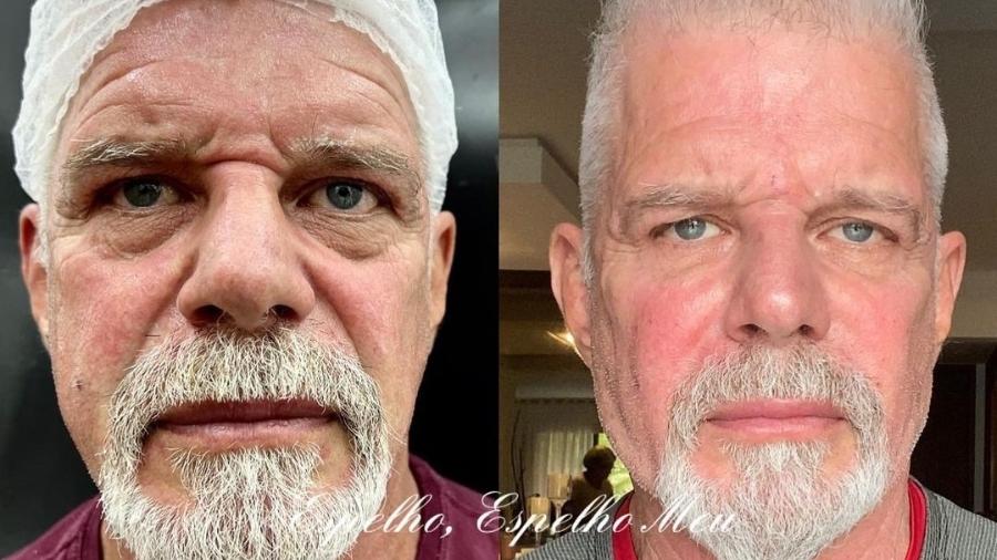 Aos 66 anos, Raul Gazolla faz harmonização facial  - Reprodução/Instagram