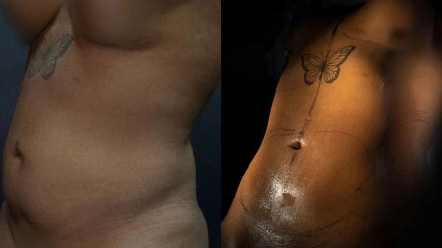 O antes e depois da Lipo Lad de Camila Loures - Reprodução/Instagram