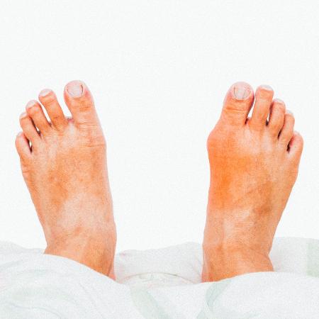 A gota causa dor e inchaço nas articulações dos pés, mãos e outras regiões - Getty Images