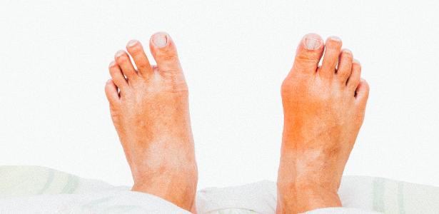 Alimentos no recomendados para acido urico