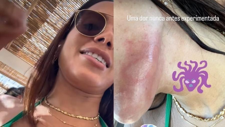 Anitta contou que foi 'atacada' por uma água-viva em uma gruta na Espanha