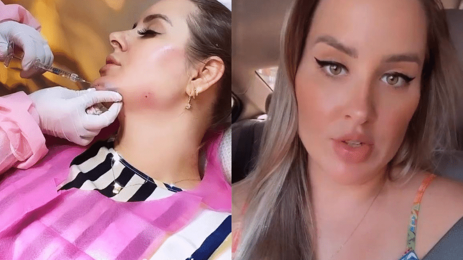 Patrícia Leitte durante e depois dos procedimentos no rosto - Reprodução/Instagram/@patricialeitteoficial