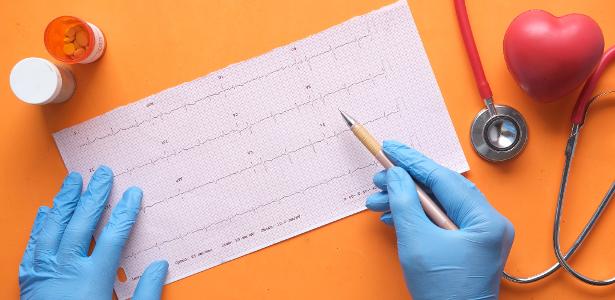 An ECG can be done at home; how will it work?