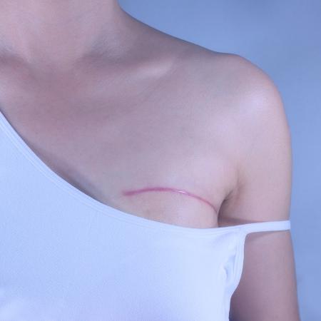 Hospital de Uberlândia (MG) deve indenizar em R$ 100 mil uma mulher que passou por cirurgia de retirada parcial de mama sem necessidade - Getty Images/iStockphoto