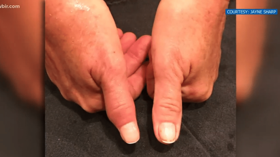 Imagem de como ficou o dedo da americana Jayne Sharp após retirada da carne prejudicada pela bactéria - Reprodução/Khou11