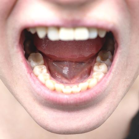 Ferida na boca que não cicatriza é sintoma mais comum - Getty Images