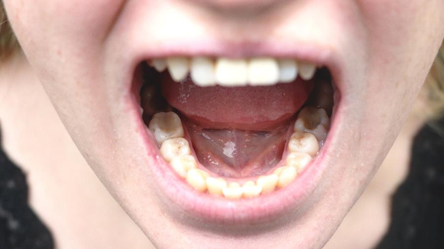 Quantos dentes temos na boca? Entenda a dúvida comum - Getty Images