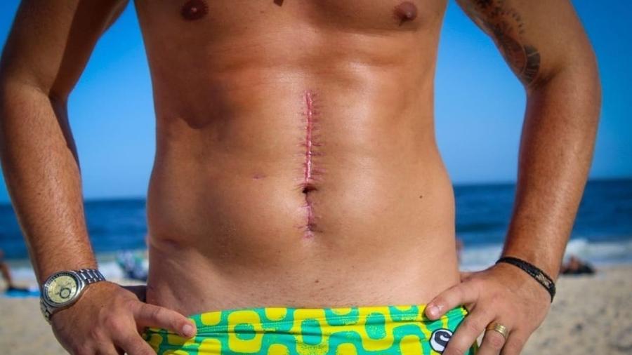 Bruno Miranda, o Borat do programa "Amor & Sexo", mostrou a cicatriz na barriga após tiro - Reprodução/Instagram