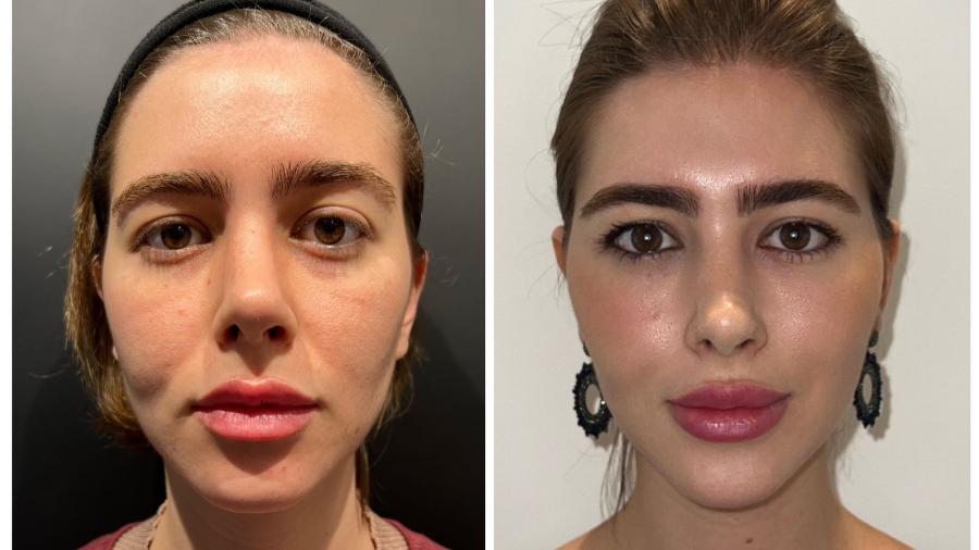 Ana Carolina descartou o ácido hialurônico e melhorou o aspecto do rosto com aplicação de gordura