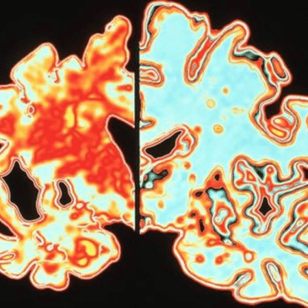 O cérebro de alguém com Alzheimer (à esquerda) comparado ao de alguém sem a doença (à direita) - Science Photo Library
