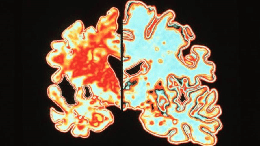 O cérebro de alguém com Alzheimer (à esquerda) comparado ao de alguém sem a doença (à direita) - Science Photo Library