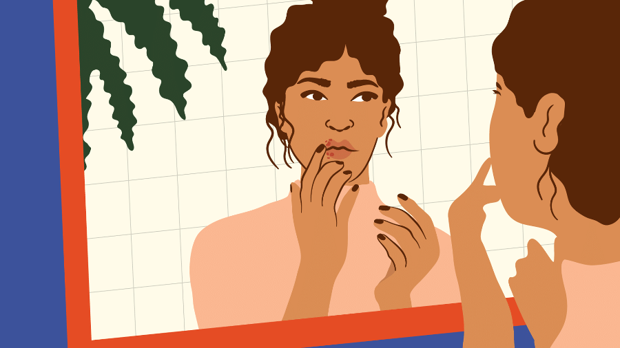 O herpes causa feridas na pele e não tem cura. A doença fica "inativa" no corpo e pode voltar sempre que há uma queda de imunidade - Camila Rosa/VivaBem