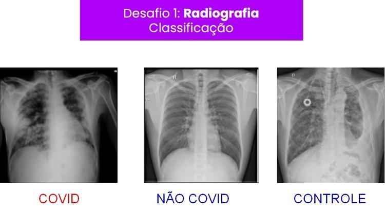 Imagens de pulmão de pacientes com e sem coronavírus apresentadas no sistema da NeuralMind - Divulgação - Divulgação