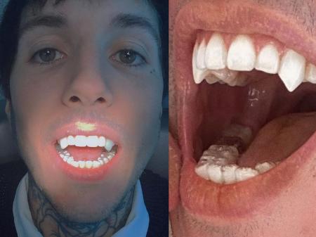 Vocalista inglês e mulher brasileira implantam presas de vampiro