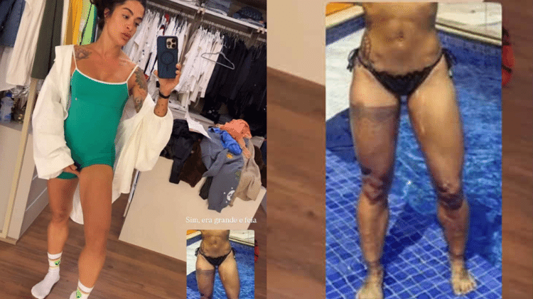 Aline Campos mostra como ficou sua perna após remover tatuagem Aline Campos mostra como ficou sua perna após remover tatuagem