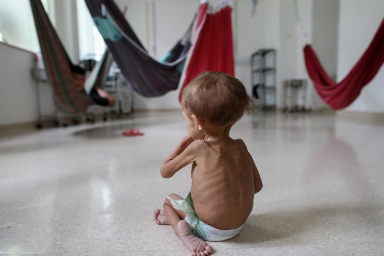 Criança Yanomami no Hospital Infantil Santo Antônio, em Boa Vista, em janeiro de 2023 Criança Yanomami no Hospital Infantil Santo Antônio, em Boa Vista, em janeiro de 2023