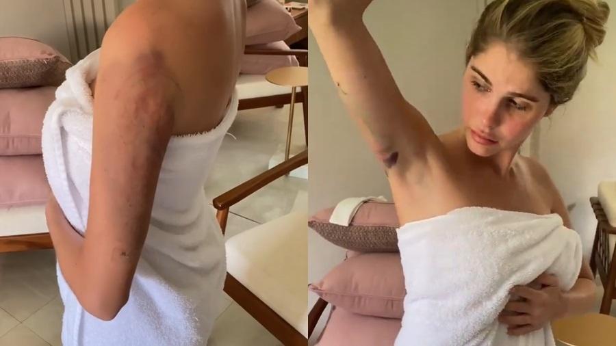 Bárbara Evans mostrou aos seguidores os hematomas após lipoaspiração no braço - Reprodução/Instagram