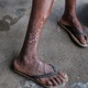Pessoa com problema de pele devido a água poluída da Baía de Guanabara. - Andrew Johnson - Andrew Johnson