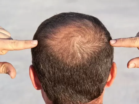 Caindo muito? Veja 5 causas comuns para a queda de cabelo