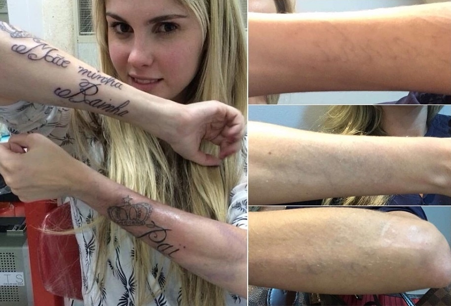 14.jan.2016 - Bárbara Evans comemorou no Instagram a remoção de suas tatuagens nos braços. Em 2013, ela foi muito criticada nas redes sociais por tatuar 
