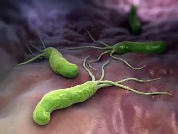 H. pylori é grave? Saiba o que é a bactéria, causas, sintomas e tratamento