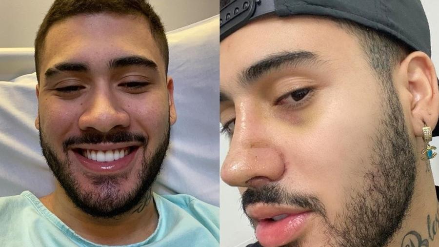 Kevinho: antes e depois de cirurgia - Reprodução/Instagram