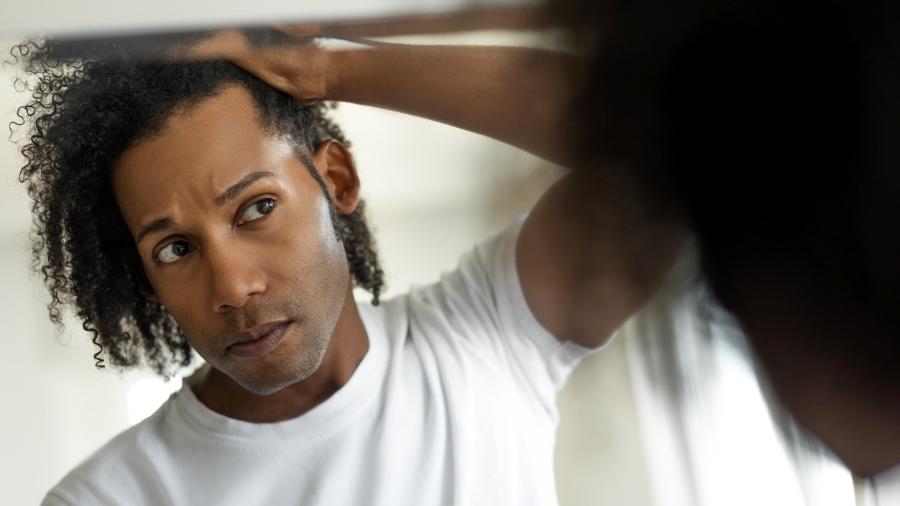 As lesões no couro cabeludo geralmente são escondidas pelos fios, o que atrasa o diagnóstico  - iStock