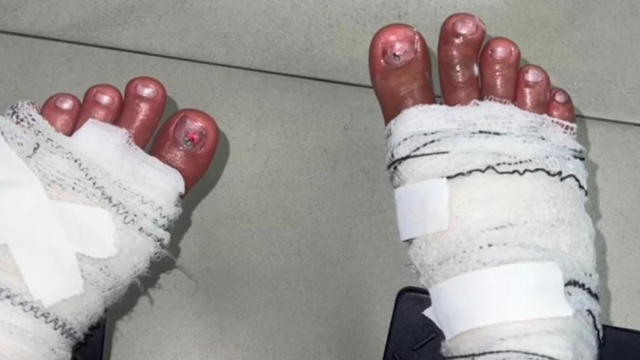 MC Thammy teve os pés queimados durante prova - Reprodução/ Instagram