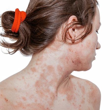 As células da pele desmascaram substâncias químicas indutoras de alergia - iStock