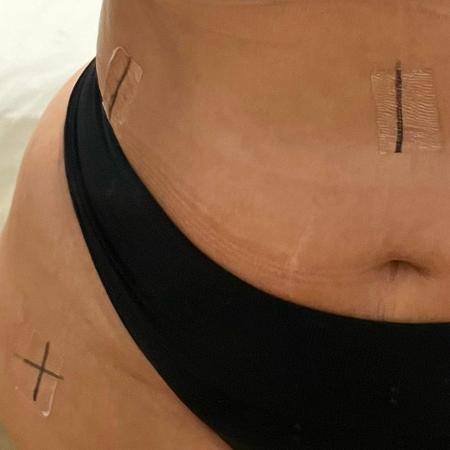 Bruna Tenório mostra cicatrizes de histerectomia que realizou para tratar câncer