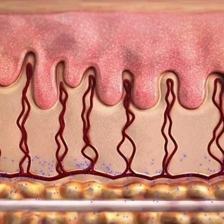O tubinho de silicone é colocado sob a pele do bumbum e libera microdoses de hormônios - 