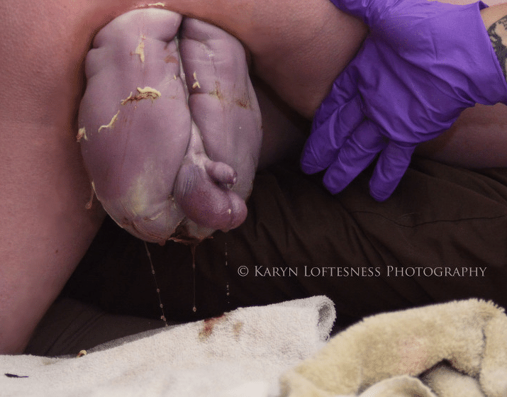 A situação é chamada de parto pélvico, quando a criança está "sentada" na barriga da mãe, e não com a cabeça encaixada. - Reprodução/Karyn Loftesness Photography
