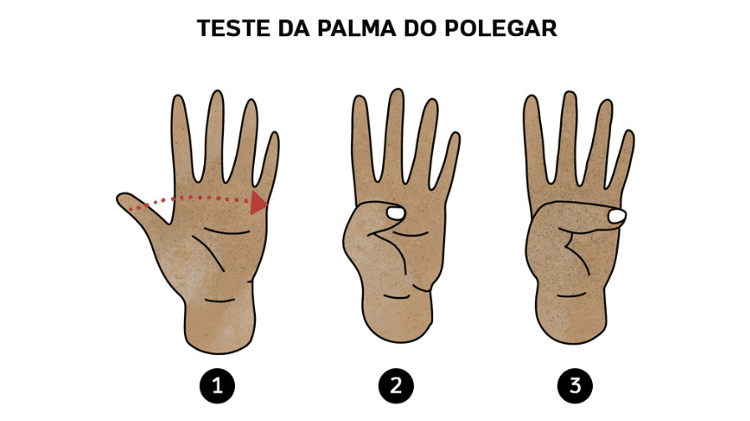 Segundo a teoria, se o dedão ultrapassar a extremidade da palma da mão, é sinal de risco Segundo a teoria, se o dedão ultrapassar a extremidade da palma da mão, é sinal de risco