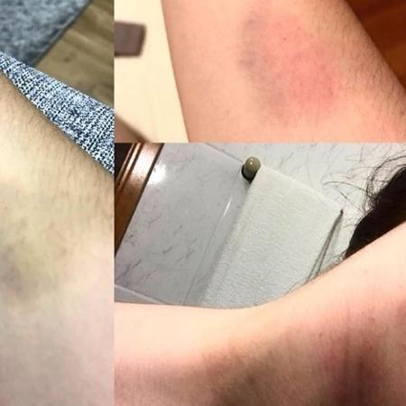 Jeniffer mostrou nas redes sociais as marcas das agressões que disse ter sofrido de Douglas - Reprodução/Instagram - Reprodução/Instagram