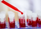 Um exame de sangue para acompanhar o tratamento da esclerose múltipla