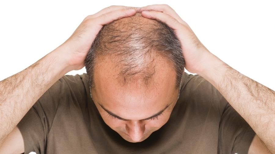 Saiba o que funciona e o que tomar para tratamento de queda de cabelo - iStock
