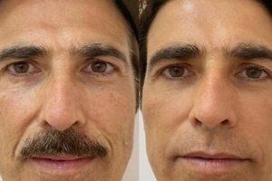 Reynaldo Gianecchini Does Facial Rejuvenation I M Impressed Ruetir