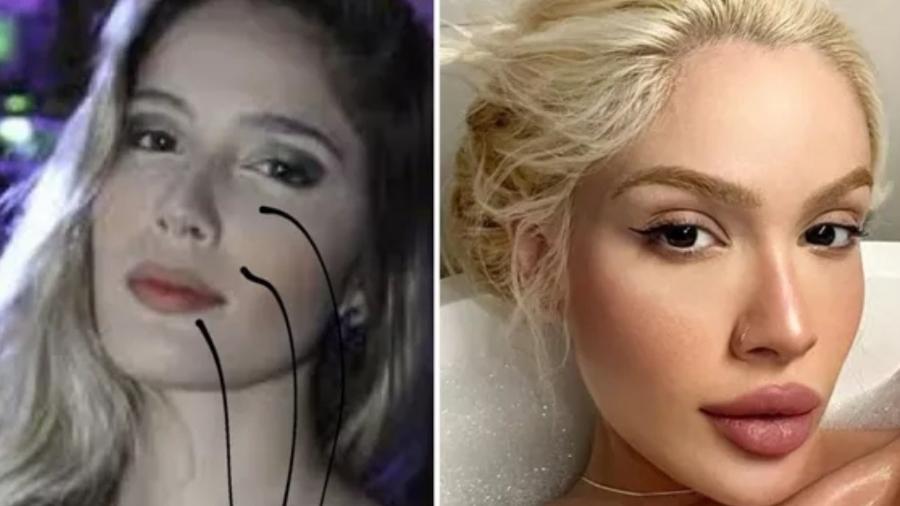Karoline Lima exibe antes e depois de procedimentos estéticos - Reprodução/Instagram