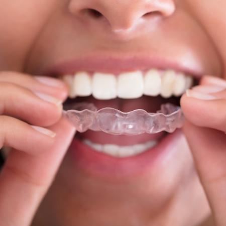 As chamadas placas oclusais são usadas por pacientes com bruxismo, doença que provoca o ranger ou apertar dos dentes durante o sono - Istock 