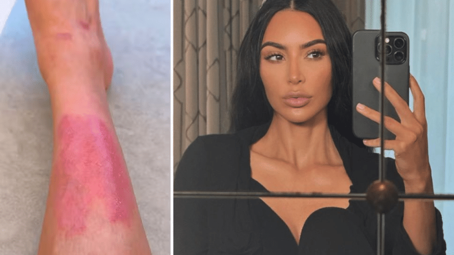 Kim Kardashian publicou imagens de lesões no Instagram