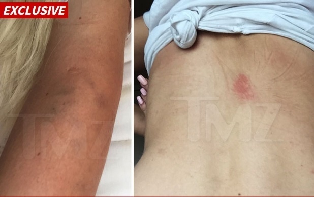 Mulher que acusa Chris Brown e a equipe dele de agressão mostra ferimentos ao site TMZ