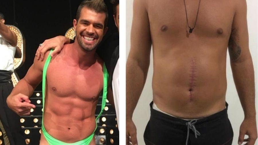 Bruno Miranda mostra cicatriz no abdômen depois do tiro - Reprodução/Instagram